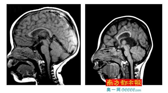 正常人的头颅(左)和小头症患者的头颅(右)对比。小头症患者的头颅明显小于常人，完全发育后头围也不超过42厘米。