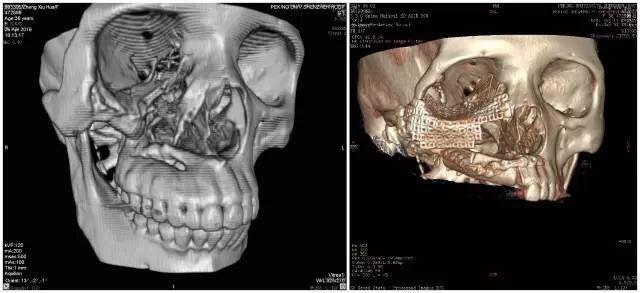 手术前（左图）、手术后三维图对比。
