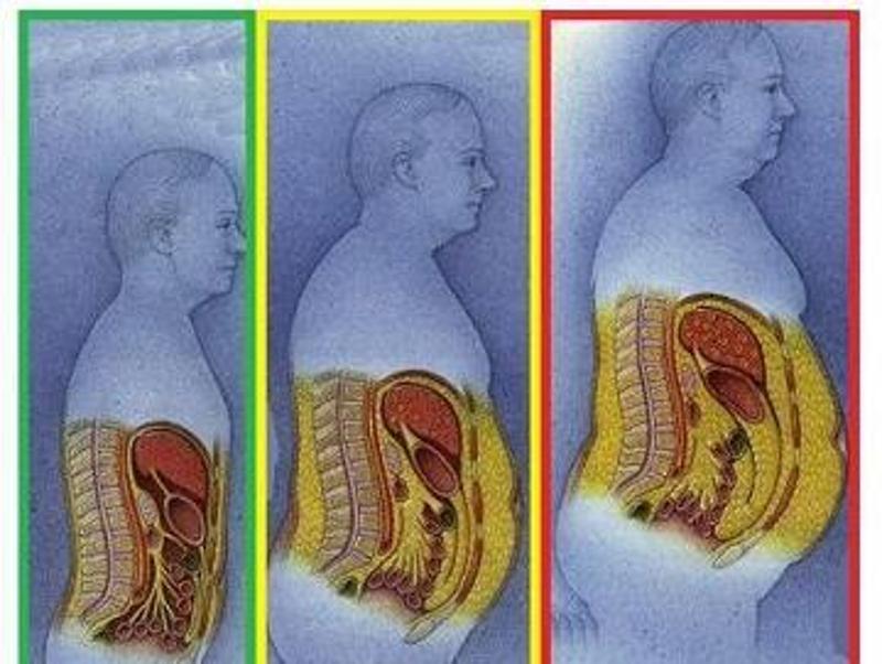 心脏病—内脏脂肪最伤心