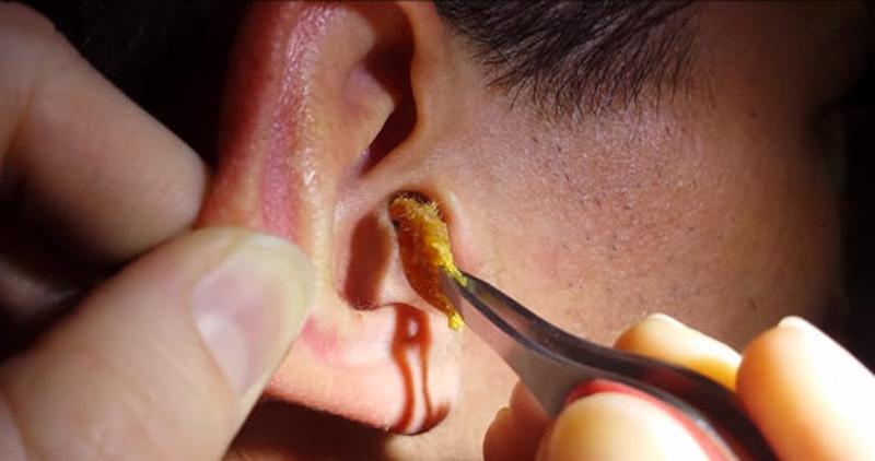多余的耳垢如果被自己掏耳朵的动作挤到了耳朵深处而形成耳垢耳垢栓塞