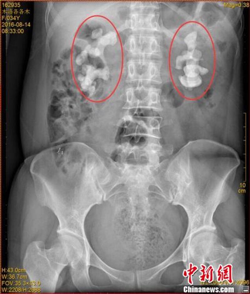 各各木术前影像图片，红圈内为巨大肾结石。　钟欣　摄