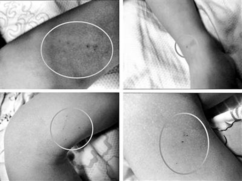 庆庆身上被发现结痂的针刺伤共有10处