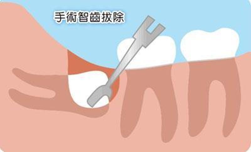 只是,在考量智齿拔除后,患者会因为伤口疼痛,红肿而造成影响进食,因此