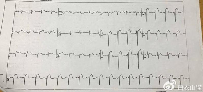 移除他的急性下壁前壁心梗的心电图