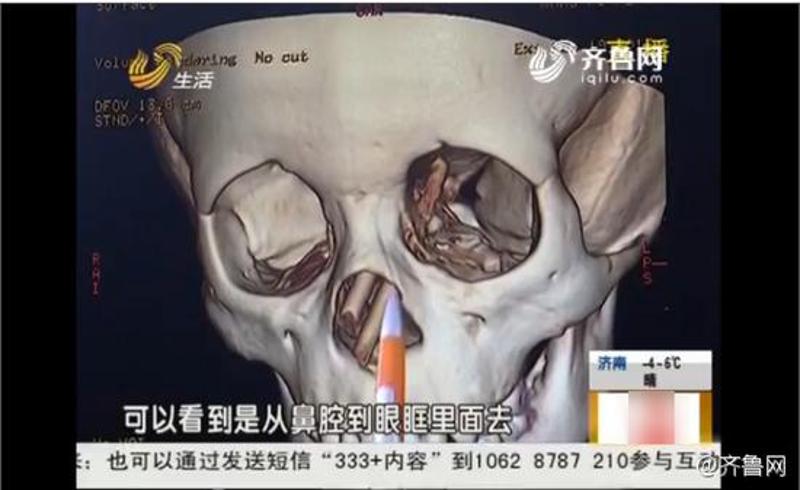 男童摔倒两根筷子插入鼻腔差1毫米刺破眼球