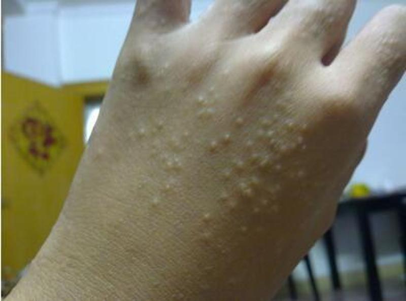 汗疱疹是一种十分常见的湿疹,春夏秋均有可能生长,冬季一般少见.