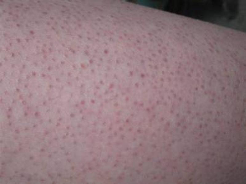 小棘苔藓   皮损主要见于颈和臀部外侧,为针头大小的丘疹,每个丘疹