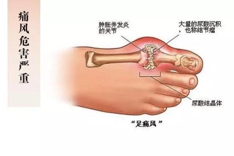 痛风只是冰山一角,痛风以外的无症状高尿酸血症危害是潜在的,持续性