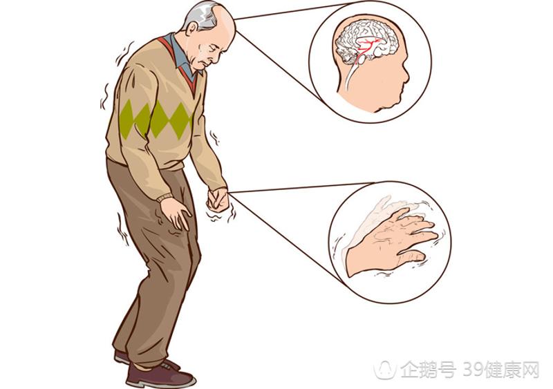 严重者大拇指会出现"数钱"的动作,帕金森病主要为静止性震颤