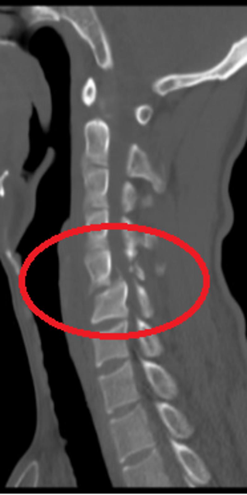 患者受伤后CT，颈5/6骨折脱位，关节突绞锁