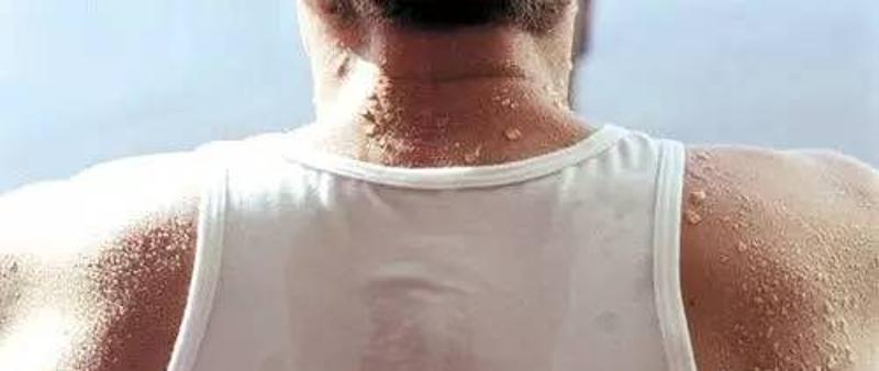 颈部出汗异常 内分泌失调   颈部汗腺不太多,若常出汗,可能与内分泌