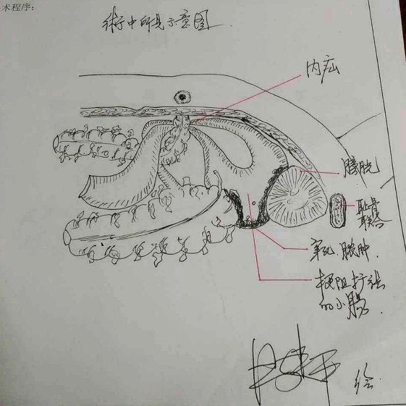 这位患者就复杂了,直肠癌术后,乙状结肠造口后出现小肠内疝一段小肠