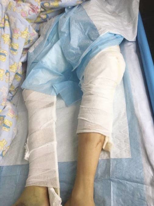 13岁男生毛毛(化名)在浙江大学医学院附属儿童医院急诊科确诊双腿严重