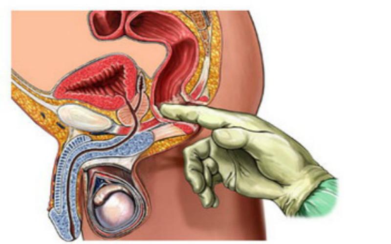 肛门指检