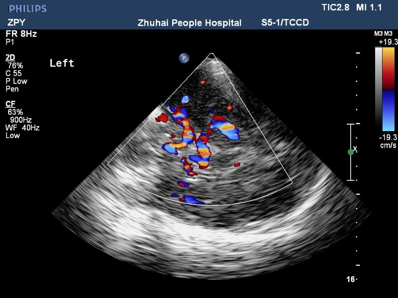 c 脑血管超声(tccd),椎动脉颅内段及基底动脉清晰可见