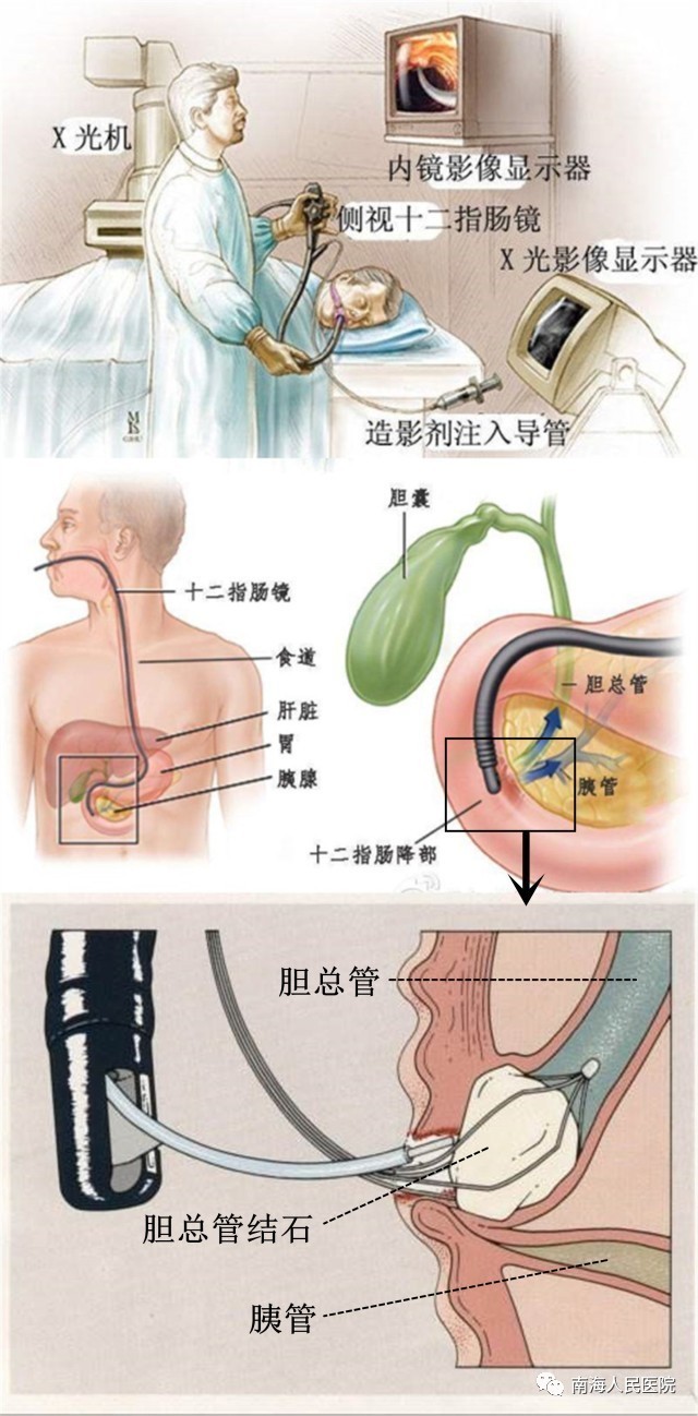 我院普外一科广泛开展内镜取石技术(ercp)治疗胆道结石