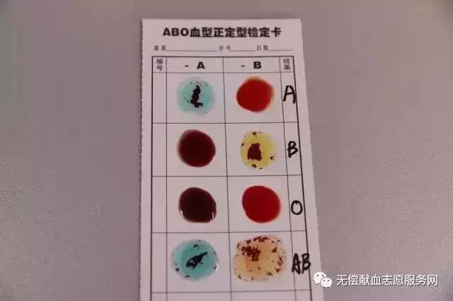 检定卡上左右两边都发生凝集    为ab型 到这里,献血前abo血型的检测