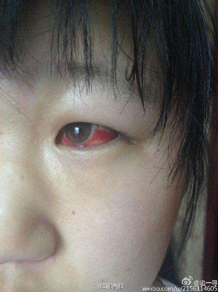 追一寻 微博截图:一名学生眼部充血的照片