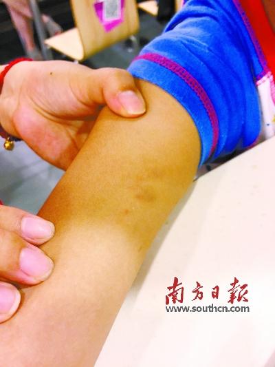 广州一小孩手臂淤青疑被老师掐紫警方介入调查