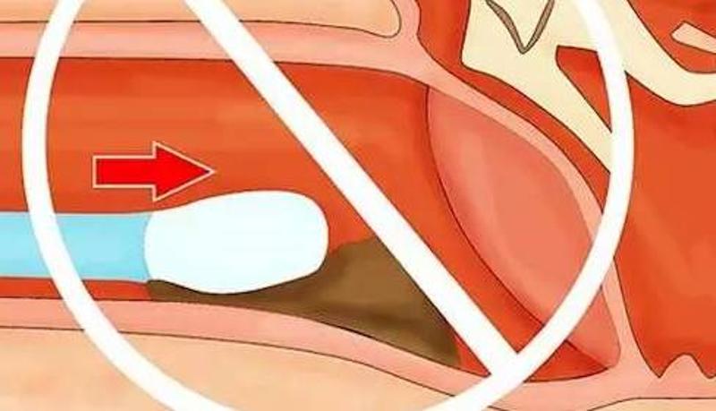 這會把耳垢推入耳朵深處,造成聽力下降,甚至損壞耳膜.