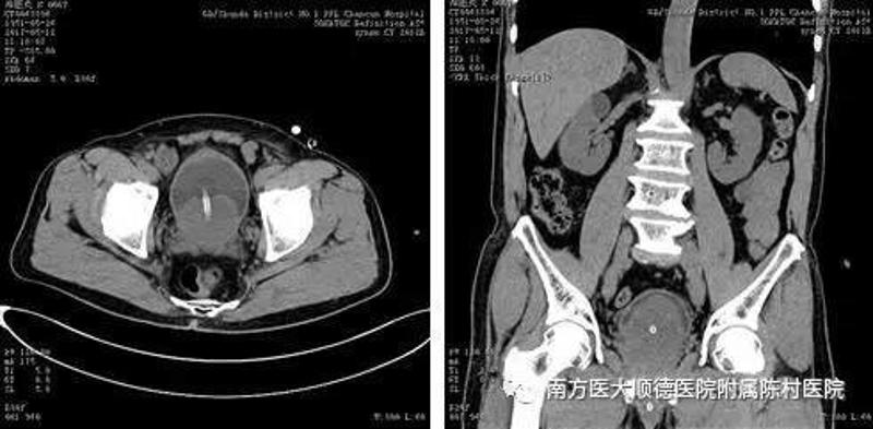 前列腺ct图片解说图图片