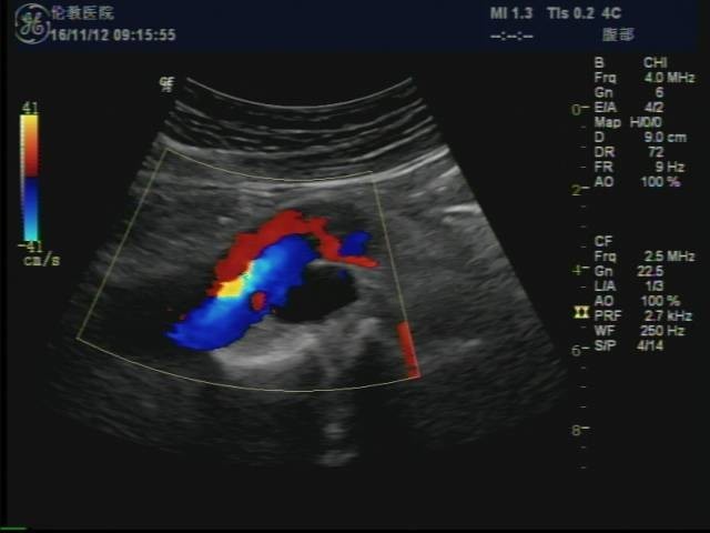 近日,一位患者因腹痛来我院检查,超声医师检查发现:腹主动脉内膜局部