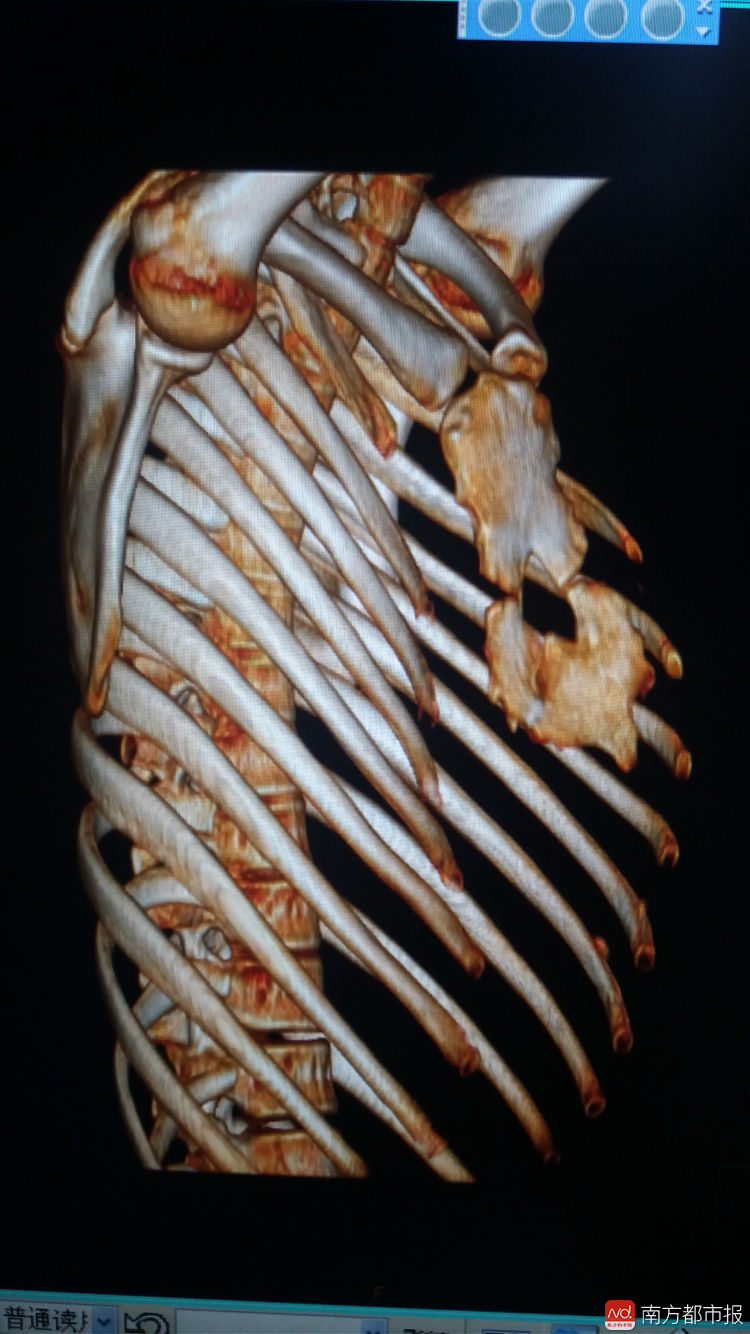 胸骨上装杠杆 用巧力将断崖拉皮 对于复杂,严重的胸廓畸形,王文林独创