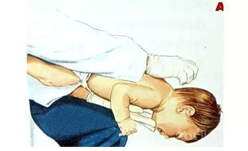 儿童腹部按压抢救图片